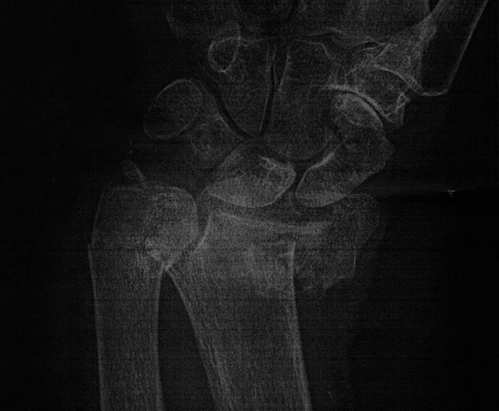 2016-05-20 Wrist X-ray (1)